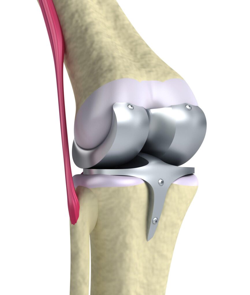 Total Knee Replacement