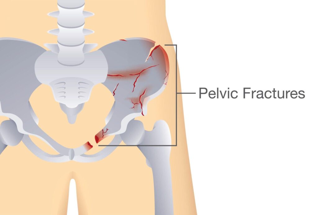 Pelvis Fracture
