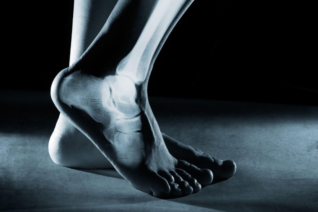 Ankle Injuries
